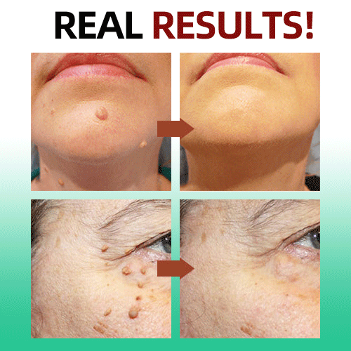 Tags & Moles Remover