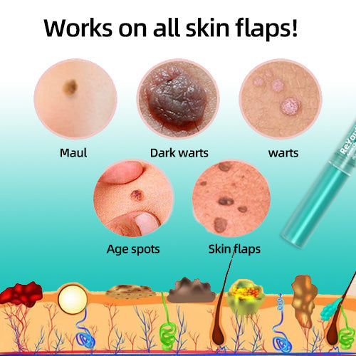 Tags & Moles Remover