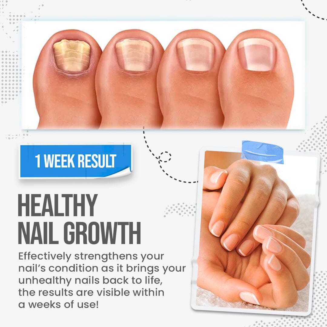 What Medication Is Used For Toenail Fungus? | Apotheco