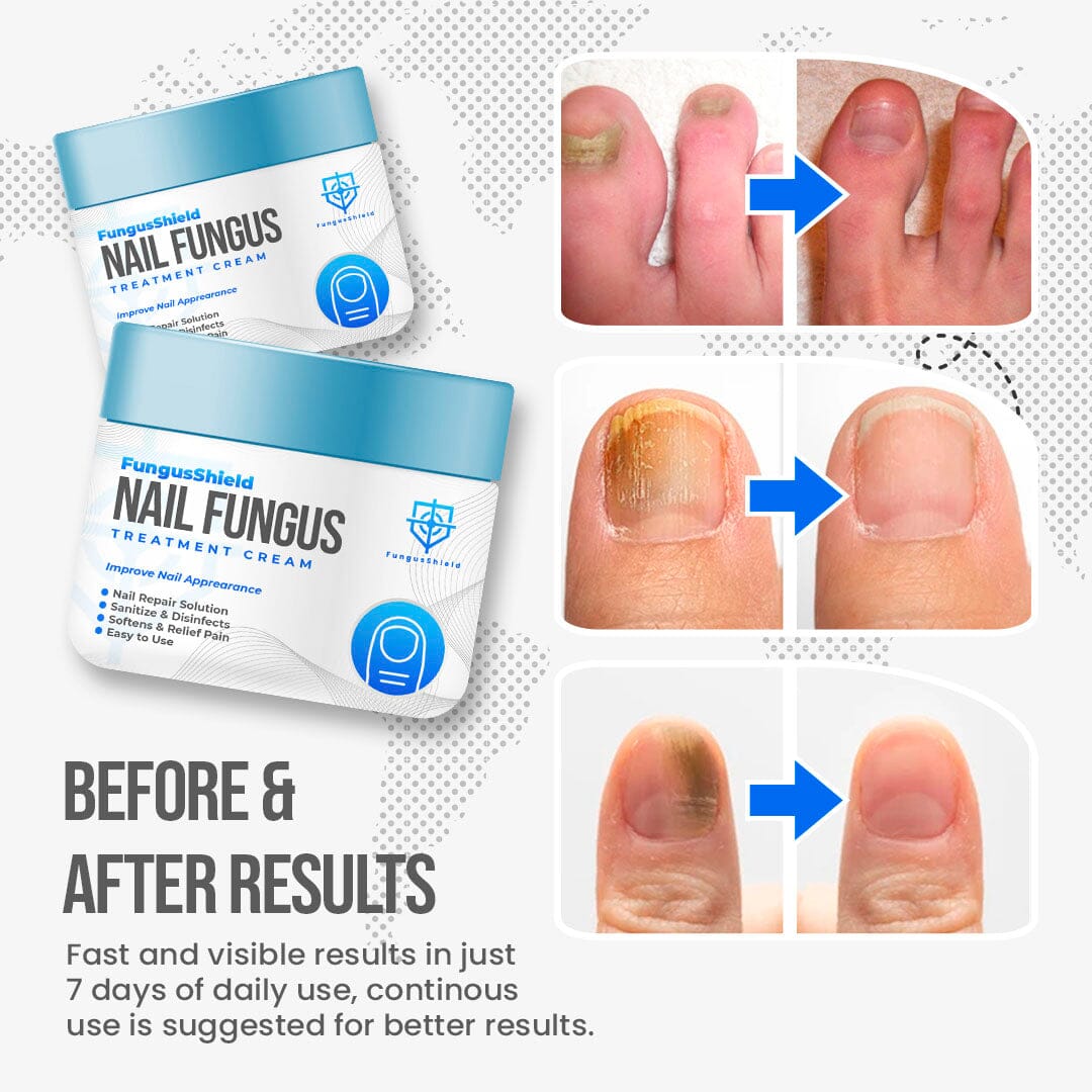 Fungal Nail Treatment Highly Effective Kill Nail Fungus For Best Result |  eBay