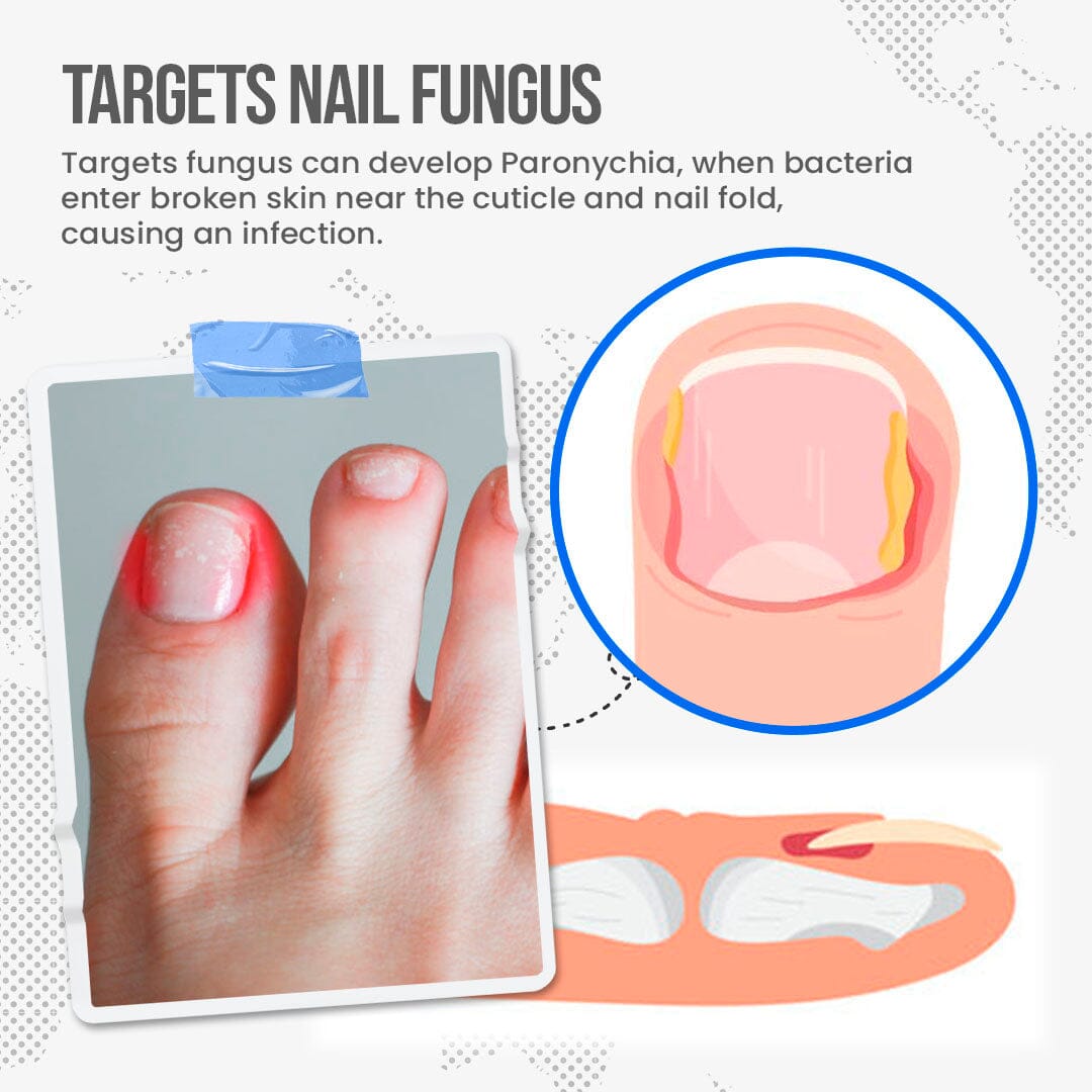 Finger Nail Infections – Are they fungal, candida or bacterial? - Compleet  Feet