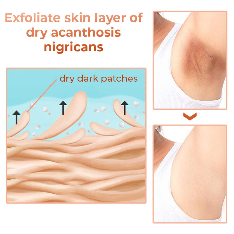 Acanthosis nigricans treatment deals